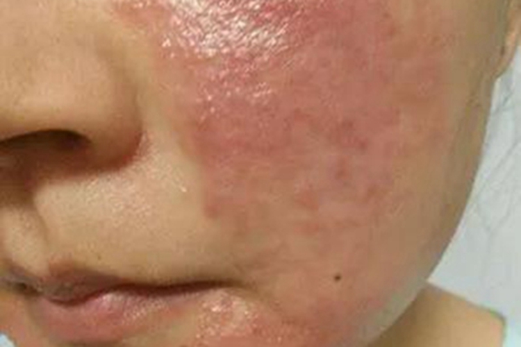 湿疹面部疙瘩图