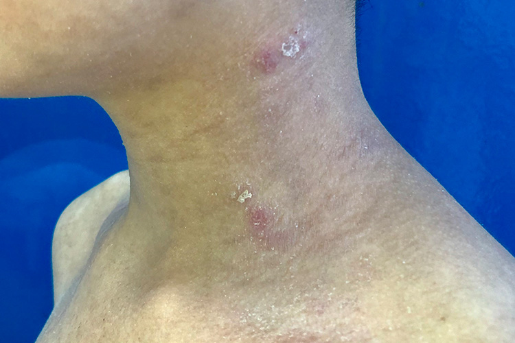 男性艾滋病初期脖子干性湿疹图
