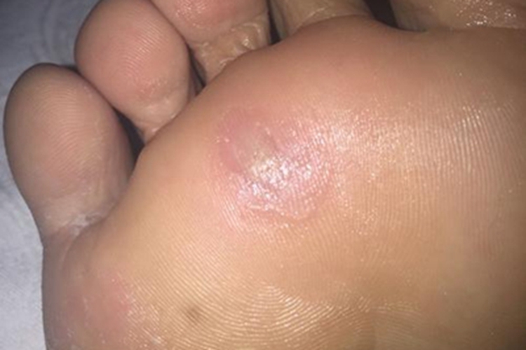 幼年跖部皮病脚底有光滑红斑图