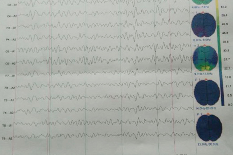 轻度异常脑电地形图 轻度异常脑电地形图