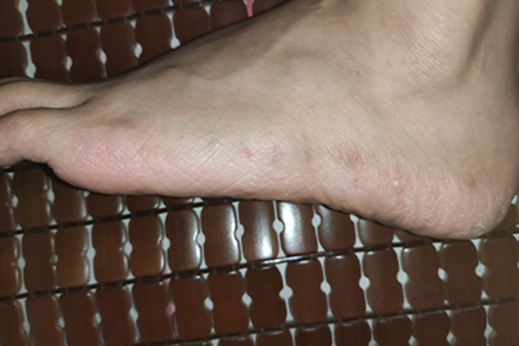 水疱型足癣脚部症状图 水疱型足癣脚部症状图