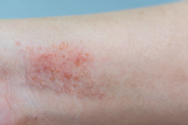 皮革皮炎手腕有小水疱图