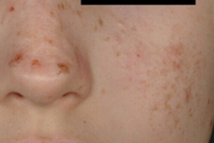 种痘样水疱病脸上结痂图 种痘样水疱病脸上结痂图