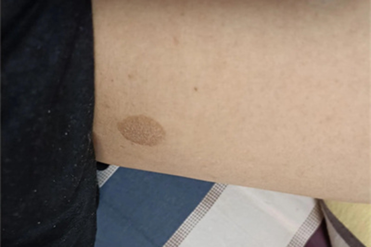 色素性紫癜性皮病大腿症状图