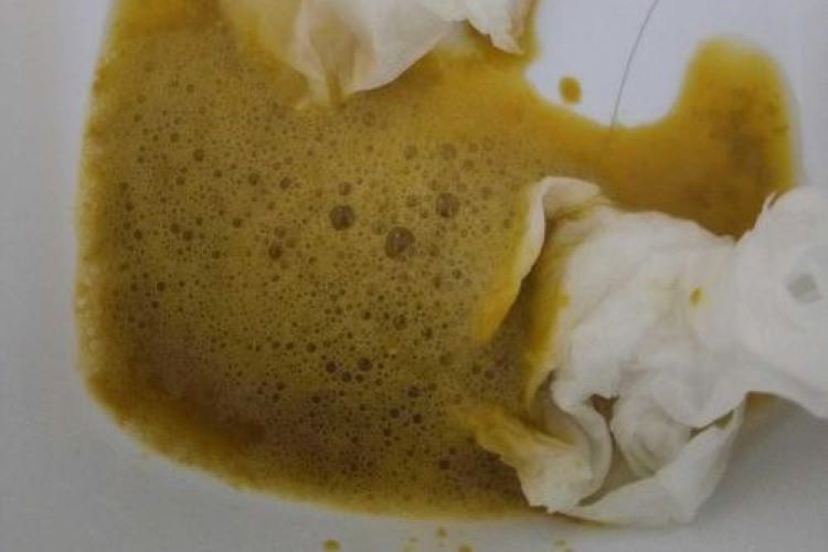 吃马蜂过敏腹泻图