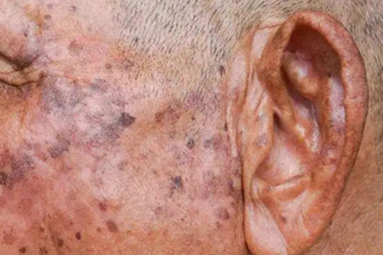 光老化面部有黑褐色斑图