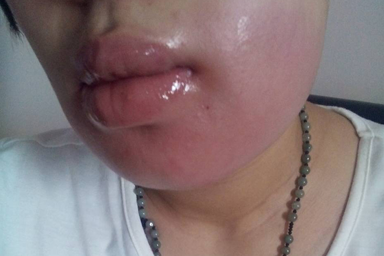 大蒜过敏口唇水肿图