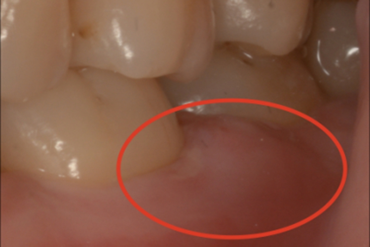 侵袭性牙周炎牙龈脓肿图 侵袭性牙周炎牙龈脓肿图
