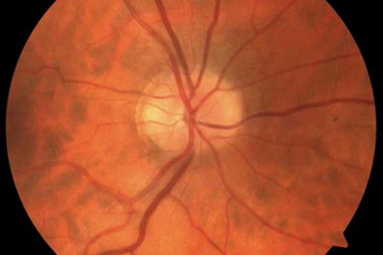 开角型青光眼图