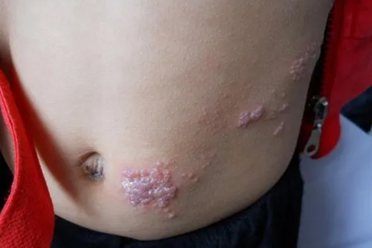 龙缠腰疱疹儿童腰部小水疱图