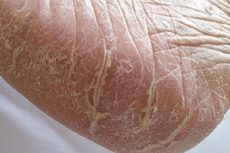 表皮松解性掌跖角皮症裂纹图