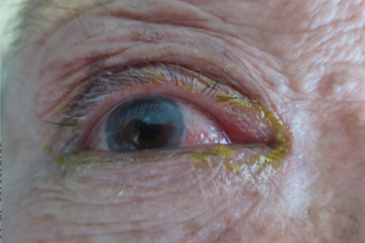眼睑淋病眼部症状图