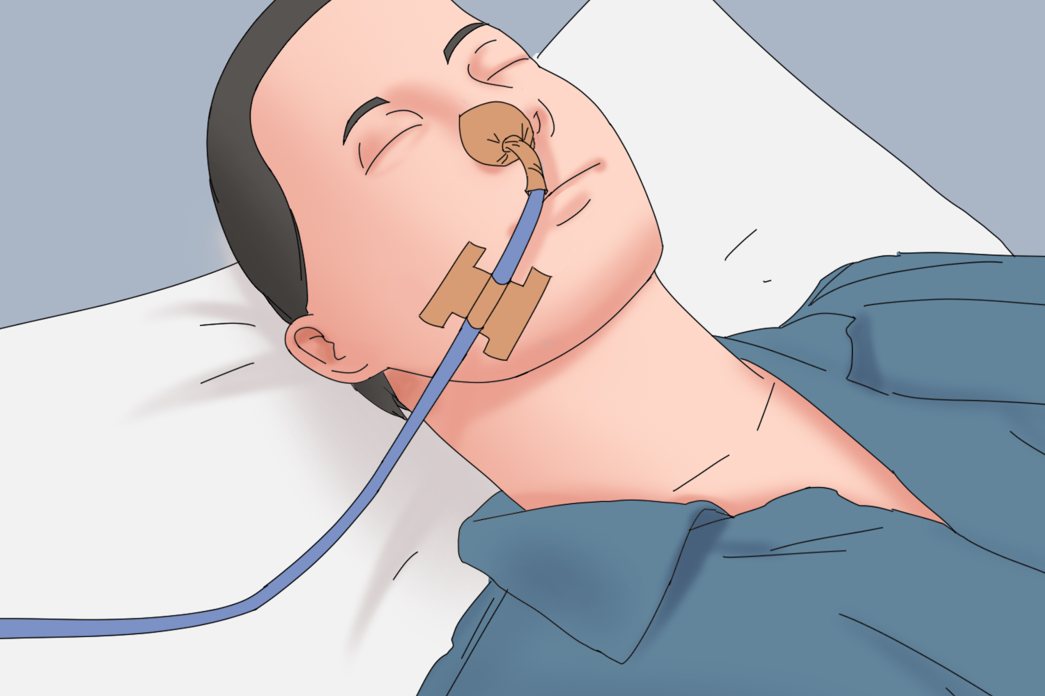 “工”型胶布联合圆角鼻贴图