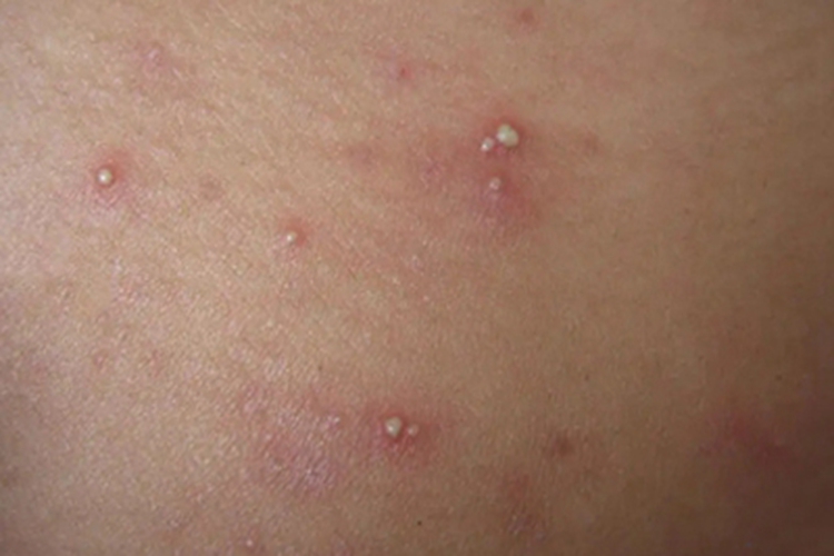 嗜酸性脓疱性毛囊炎背部脓包图