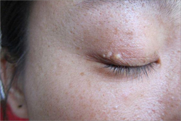 眼皮上有凸起小疙瘩