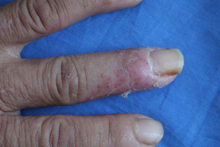 萎缩性慢性肢端皮炎红点图 萎缩性慢性肢端皮炎红点图