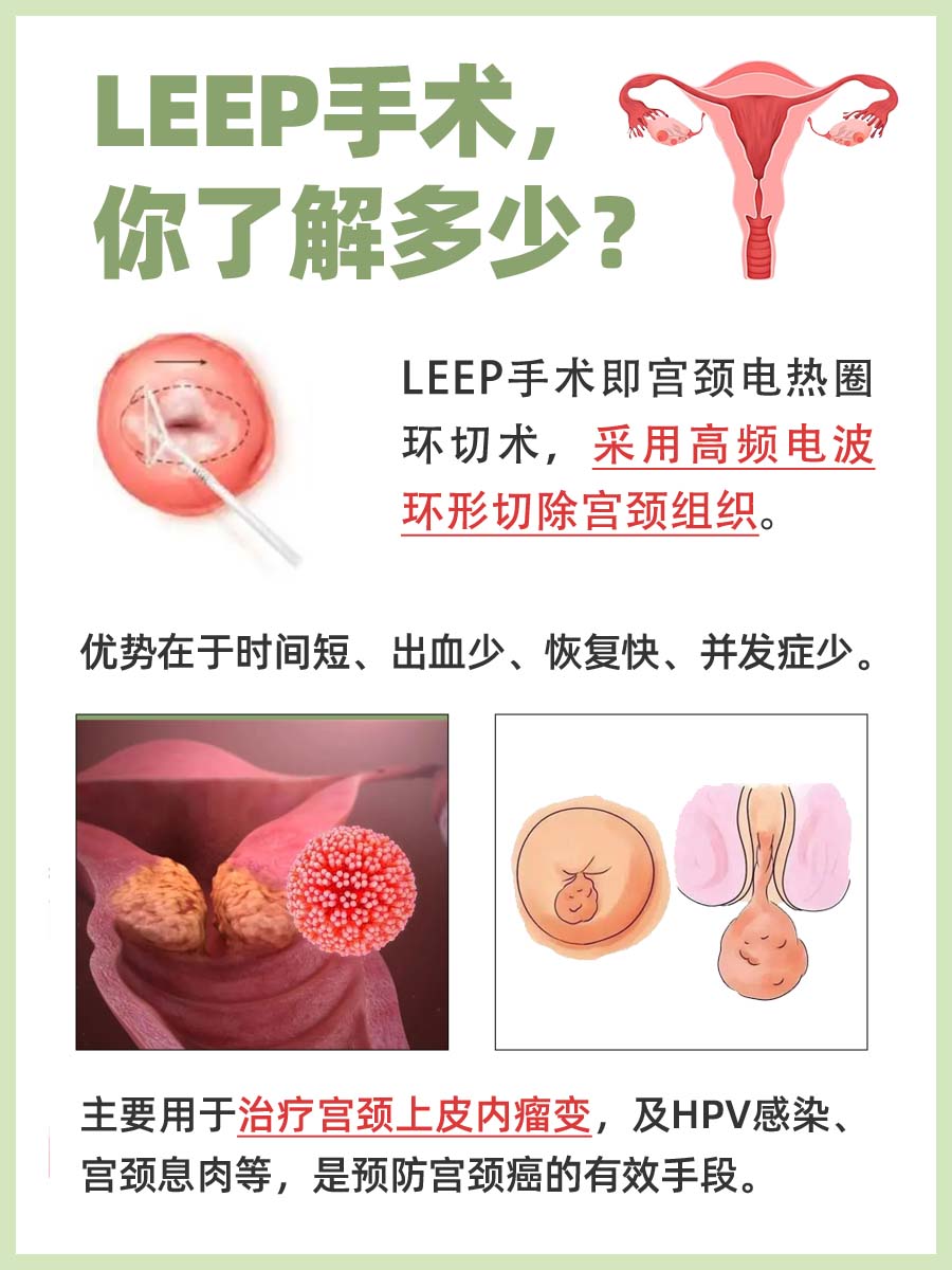 LEEP手术：精准切除，守护宫颈的温柔一刀