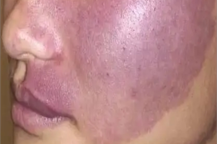 鲜红斑痣面部症状图