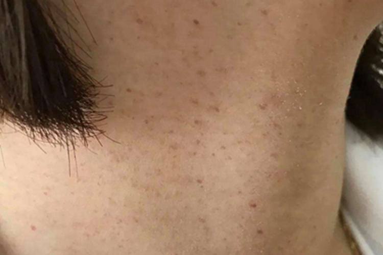 网状色素失禁症前颈斑图 网状色素失禁症前颈斑图