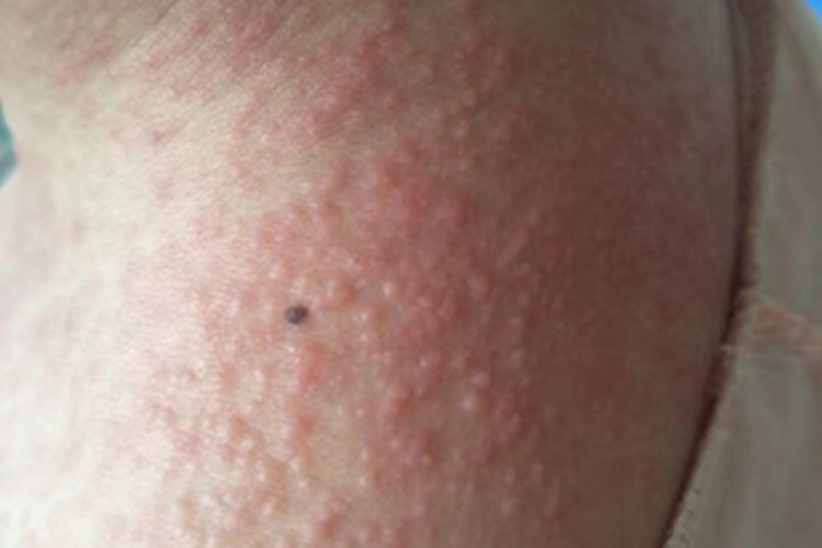 亚急性湿疹颈部症状图