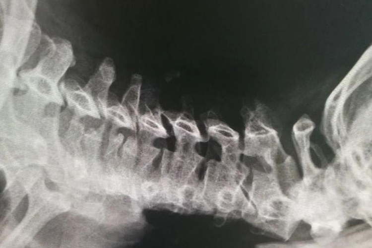 神经根型颈椎病图