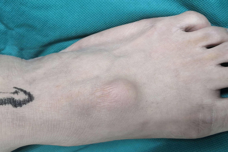 脚面腱鞘囊肿图