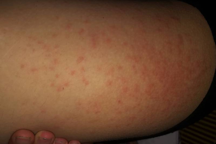 痱子大腿症状图