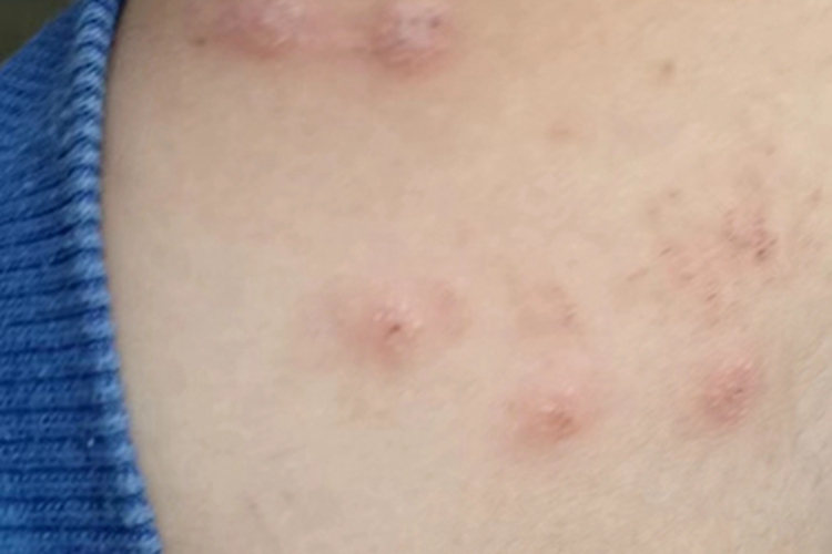 丘疹性荨麻疹背部疙瘩图 丘疹性荨麻疹背部疙瘩图