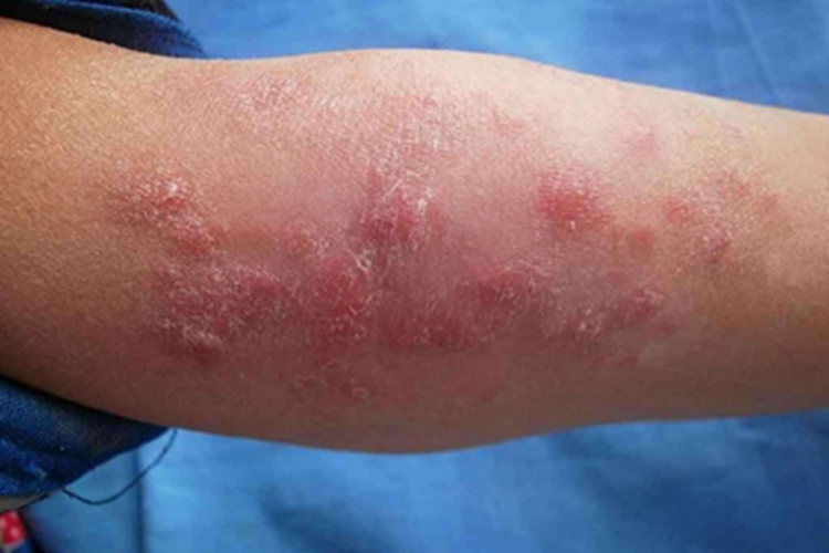 瘰疬性皮肤结核胳膊结节图 瘰疬性皮肤结核胳膊结节图