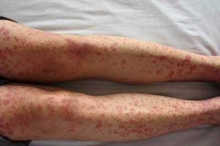 轻型多形红斑型药疹腿症状图