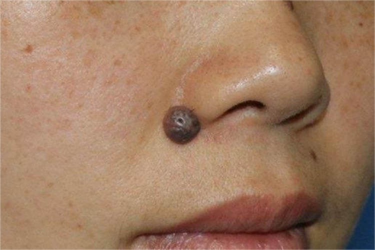 皮内痣鼻唇沟疙瘩图