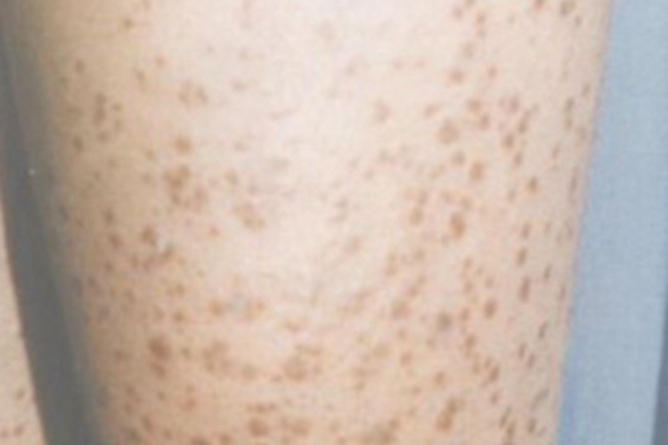 斑块型副银屑病斑图 斑块型副银屑病斑图