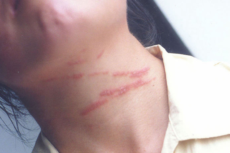 隐翅虫皮炎条状红斑图 隐翅虫皮炎条状红斑图