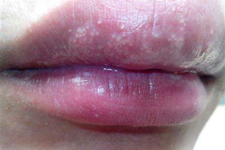 异位皮脂腺嘴唇小斑点图