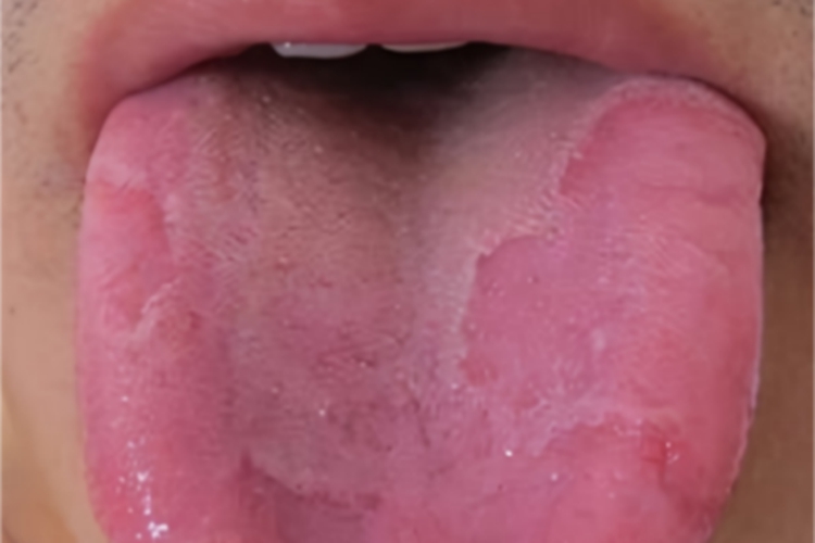 地图舌舌头上有好几片斑块图