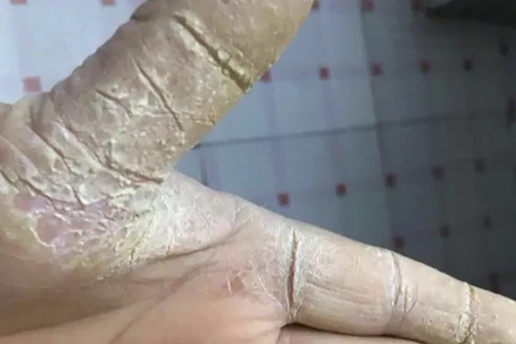 角化过度型手癣图