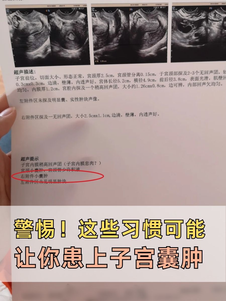 警惕！这些习惯可能让你患上子宫囊肿