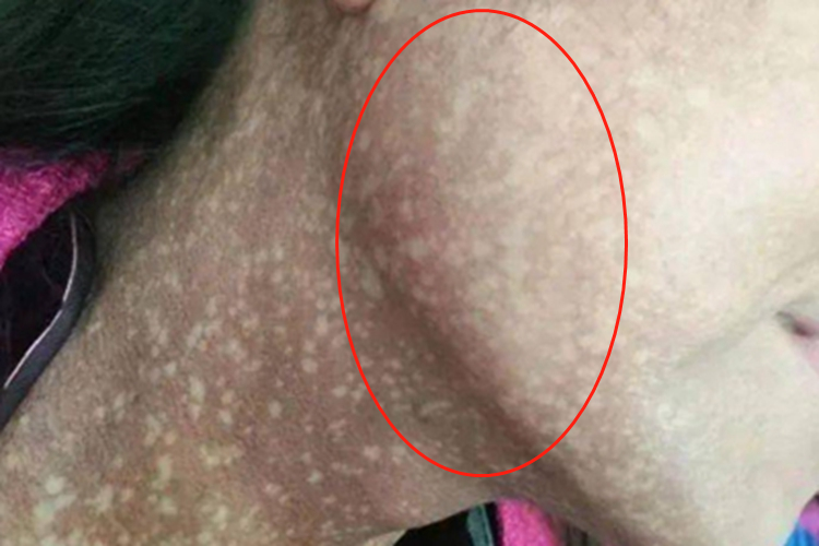 瑞尔黑变病面部红斑图 瑞尔黑变病面部红斑图