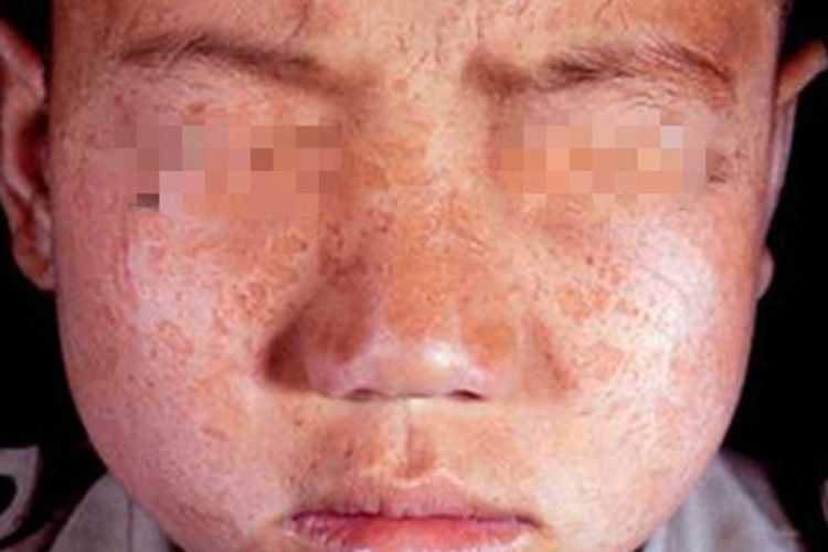 原卟啉病白斑图 原卟啉病白斑图