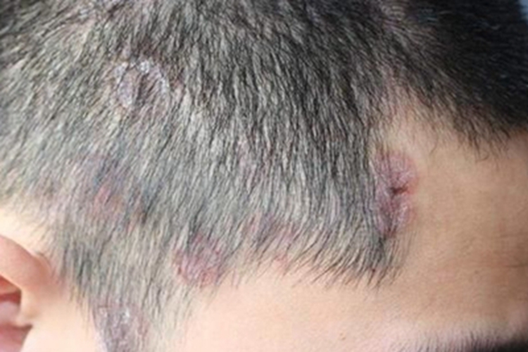 斑疹性梅毒疹头皮红斑图 斑疹性梅毒疹头皮红斑图