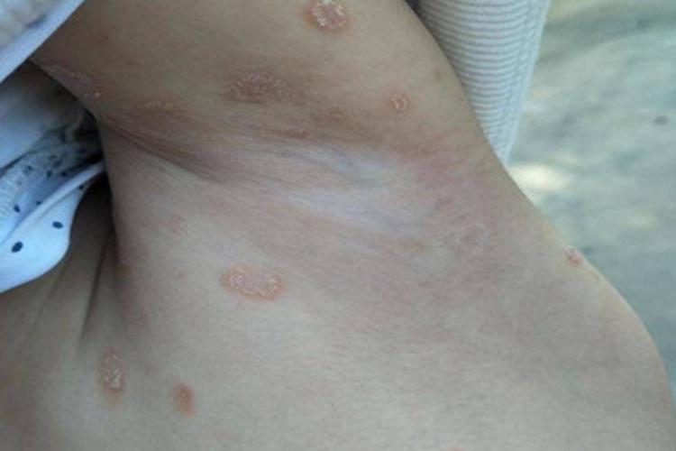 玫瑰糠疹腋窝脱屑图 玫瑰糠疹腋窝脱屑图