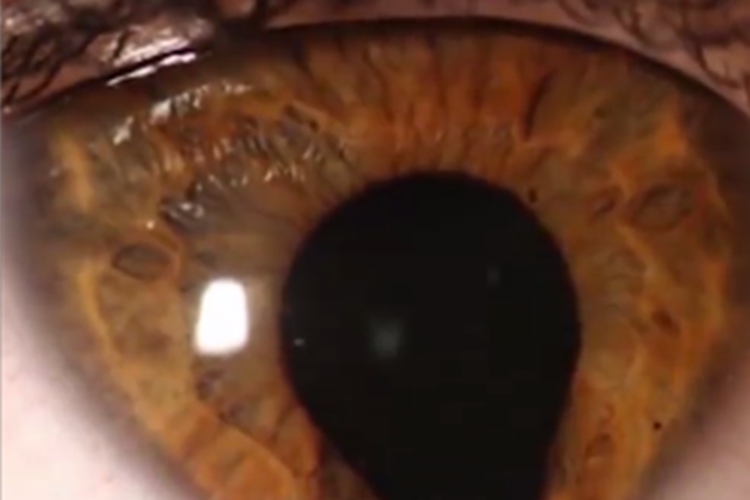 典型性虹膜缺损瞳孔变形图 典型性虹膜缺损瞳孔变形图