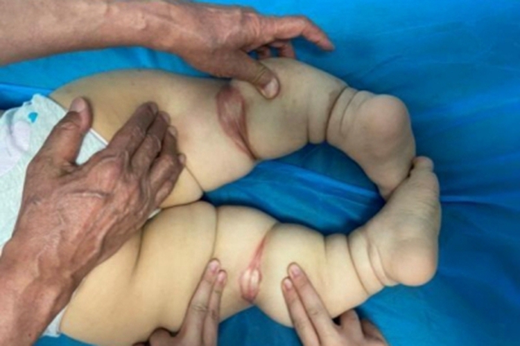 软骨发育不全小腿畸形图