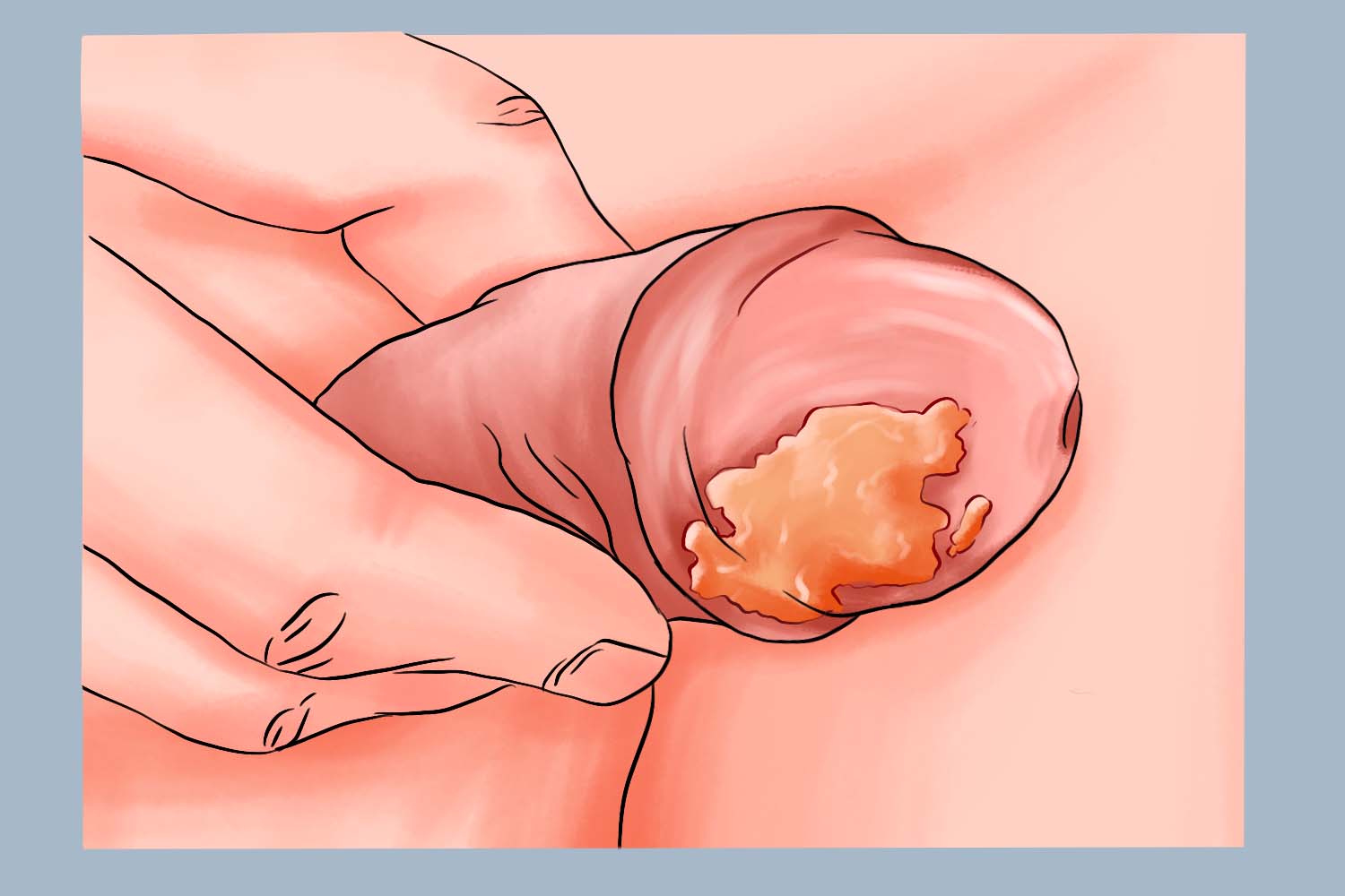 MKPEB龟头结痂图