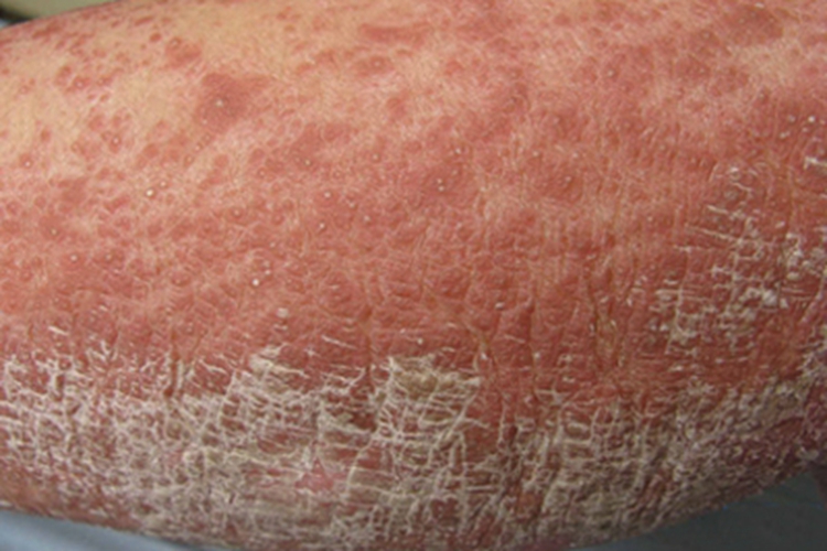 毛发红糠疹性红皮病丘疹图
