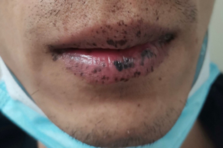 色素沉着息肉综合征嘴唇长黑斑图