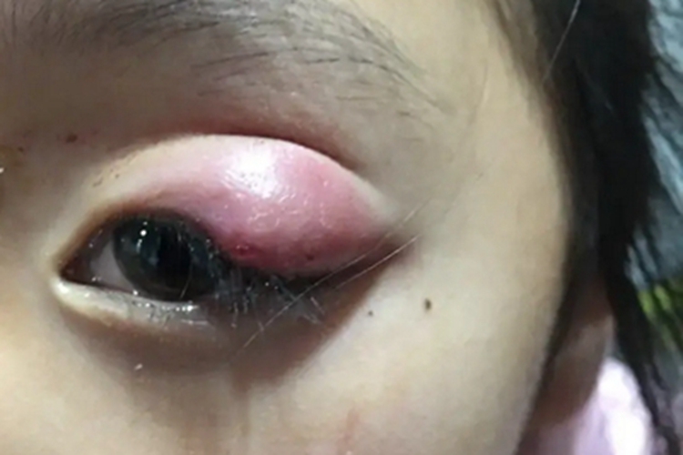 外睑腺炎眼睑圆疙瘩图 外睑腺炎眼睑圆疙瘩图