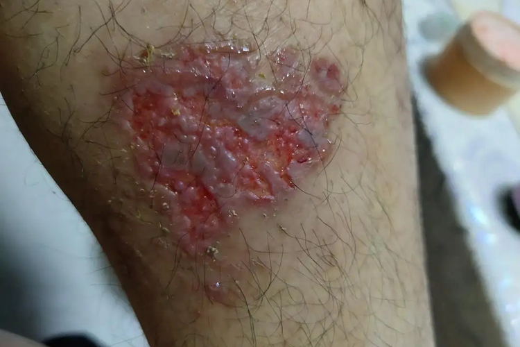 急性湿疹图 急性湿疹图