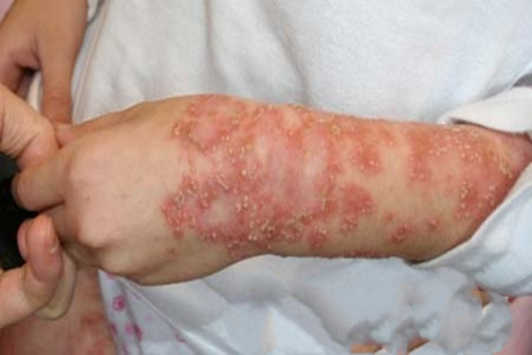 角层下脓疱病胳膊脓包图