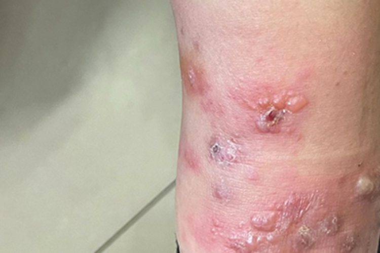 隐翅虫皮炎小腿结痂图